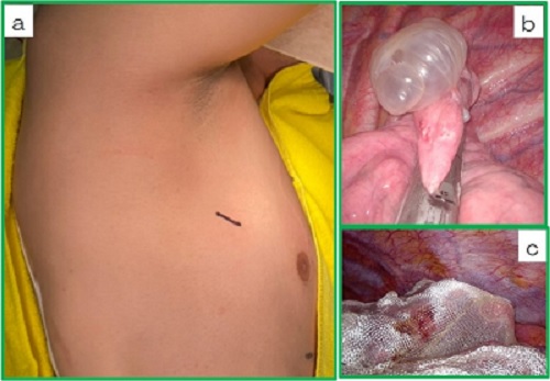 図1 自然気胸に対する単孔式胸腔鏡下嚢胞切除術