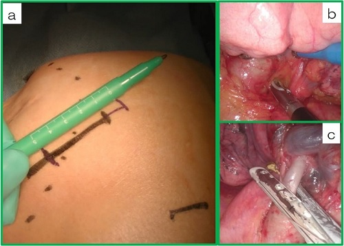 図3 肺悪性腫瘍での単孔胸腔鏡下肺葉切除術