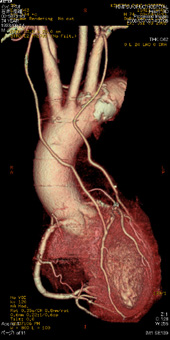 冠動脈バイパス